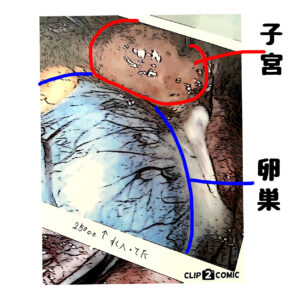 卵巣嚢腫、手術